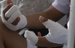 Autoridades de salud insisten en evitar uso de pólvora, ya van 53 personas lesionadas en el Valle