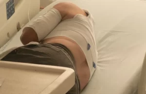 El balance de quemados en el Valle ya llegó a 82 personas, indica la Secretaría de Salud