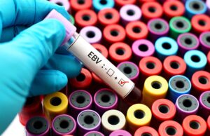 Descubren la causa principal del lupus: el virus de Epstein-Barr sería el responsable