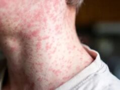 Secretaría de Salud de Cali alerta sobre síntomas del sarampión y refuerza llamado a la vacunación