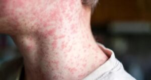 Secretaría de Salud de Cali alerta sobre síntomas del sarampión y refuerza llamado a la vacunación