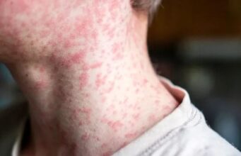 Secretaría de Salud de Cali alerta sobre síntomas del sarampión y refuerza llamado a la vacunación